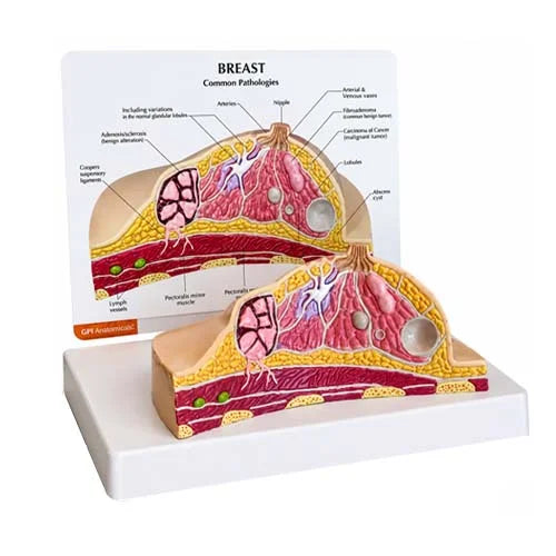 Diseased Breast Model with Common Pathologies
