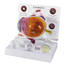 Cataract Eye Model for Patient Education and Training