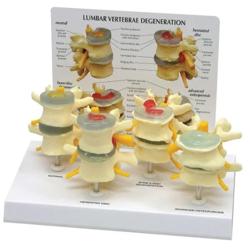 Lumbar Vertebrae Degeneration Model for Spine Education