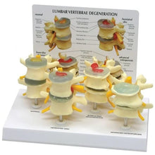 Lumbar Vertebrae Degeneration Model for Spine Education