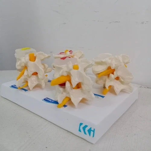 Lumbar Vertebrae Degeneration Model for Spine Education
