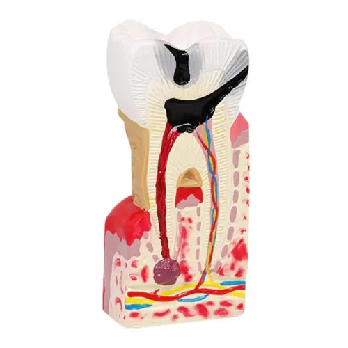 Enlarged Diseased Tooth Model with Caries & Pulp