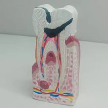Enlarged Diseased Tooth Model with Caries & Pulp