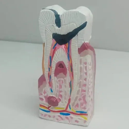 Enlarged Diseased Tooth Model with Caries & Pulp