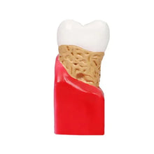 Enlarged Diseased Tooth Model with Caries & Pulp