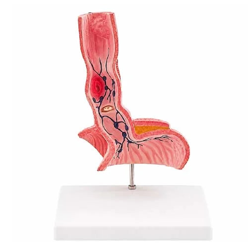 Life-Size Diseased Esophagus Model with Stomach Section