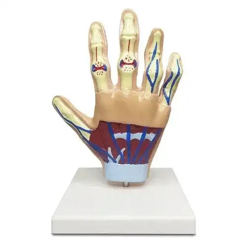 Life-Size Hand Arthritis Model with Cutaway Joints