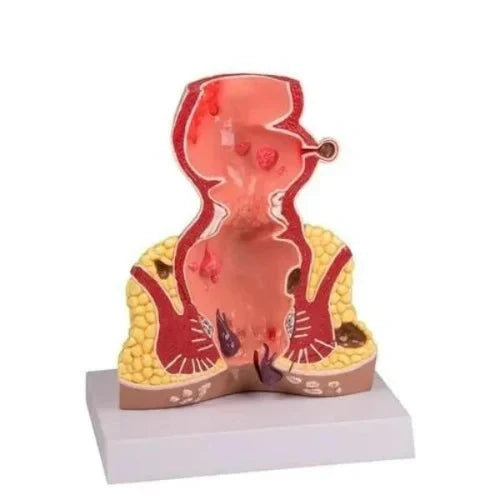 Diseased Hemorrhoids Anatomy Education Model