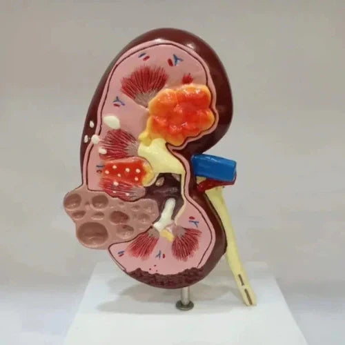 Kidney Cyst Model Deluxe for Medical Teaching
