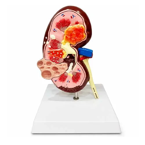 Kidney Cyst Model Deluxe for Medical Teaching