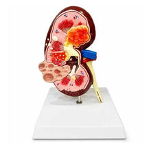 Kidney Cyst Model Deluxe for Medical Teaching