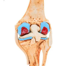 Knee Joint Arthritis Model 4 Stage Osteoarthritis Teaching Aid