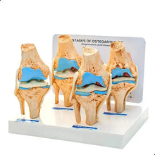 Knee Joint Arthritis Model 4 Stage Osteoarthritis Teaching Aid