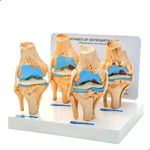 Knee Joint Arthritis Model 4 Stage Osteoarthritis Teaching Aid