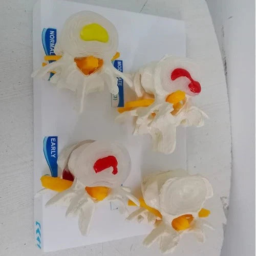 Lumbar Vertebrae Degeneration Model for Spine Education
