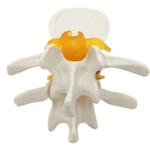 Lumbar Disc Herniation Spine Model for Teaching