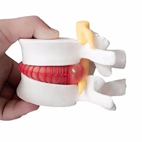 Lumbar Disc Herniation Spine Model for Teaching