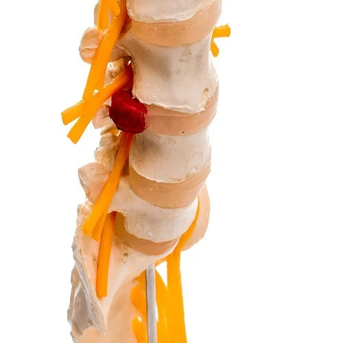 Lumbar Spine Model with Herniated Disc & Sciatic Nerve