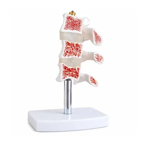 Vertebral Osteoporosis Model for Medical Education