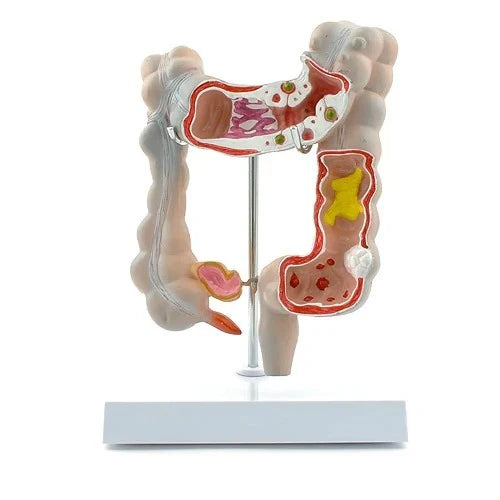 Life-Size Colon Pathological Model with Disease Views
