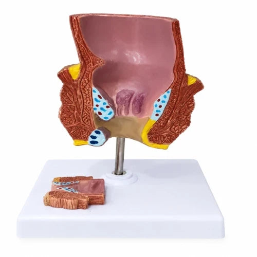 Diseased Rectum Model with Hemorrhoids & Normal Anatomy