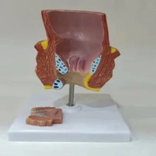 Diseased Rectum Model with Hemorrhoids & Normal Anatomy