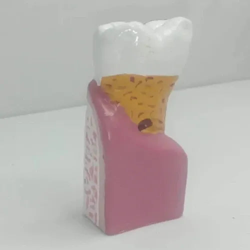 Enlarged Diseased Tooth Model with Caries & Pulp